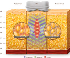 chracteristics_cavitazione