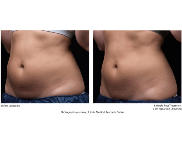 Liposonix vorher nachher