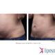 Liposonix vorher nachher