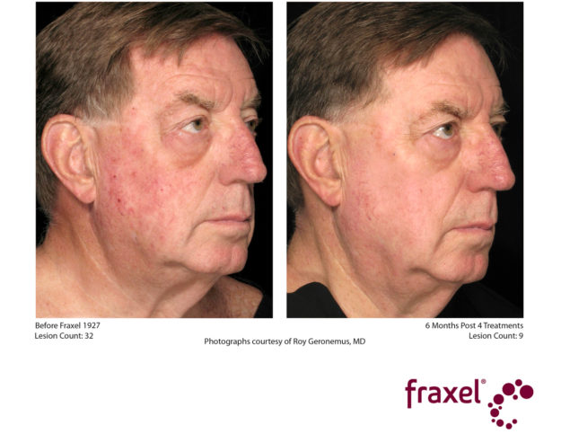 vorher nachher fraxel
