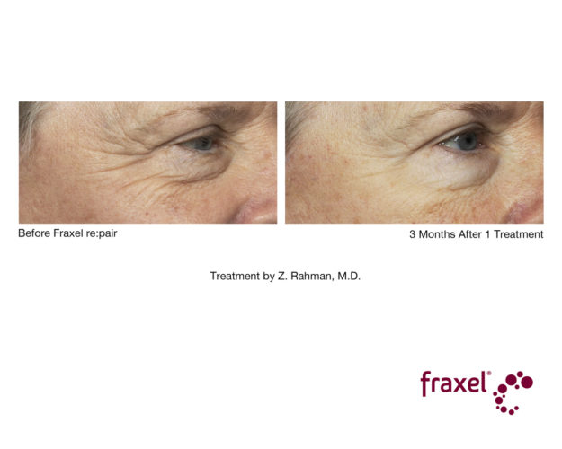 Fraxel vorher nachher