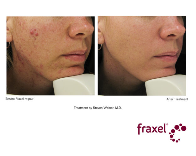 Fraxel vorher nachher