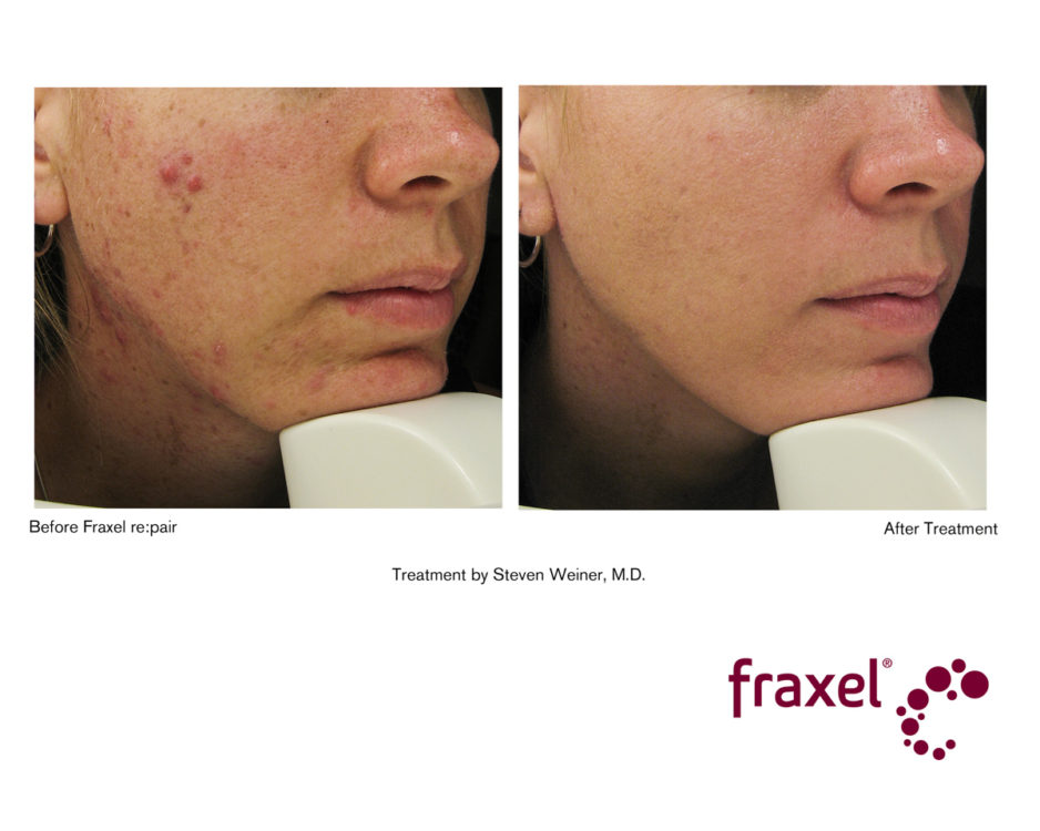 Fraxel vorher nachher