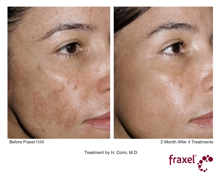 Fraxel vorher nachher