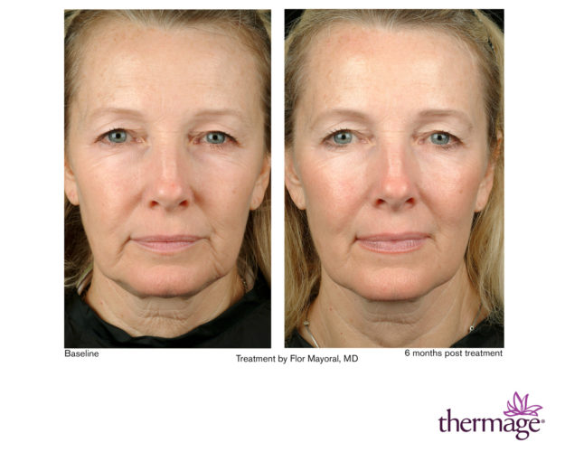 Thermage vorher nachher