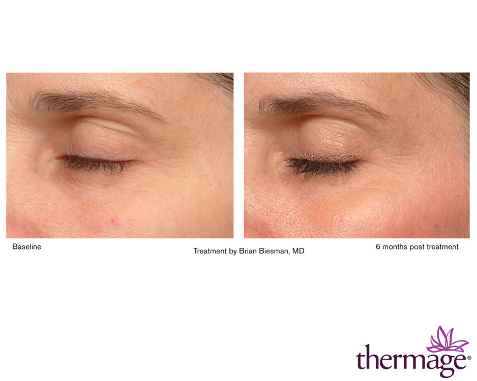 Thermage vorher nachher