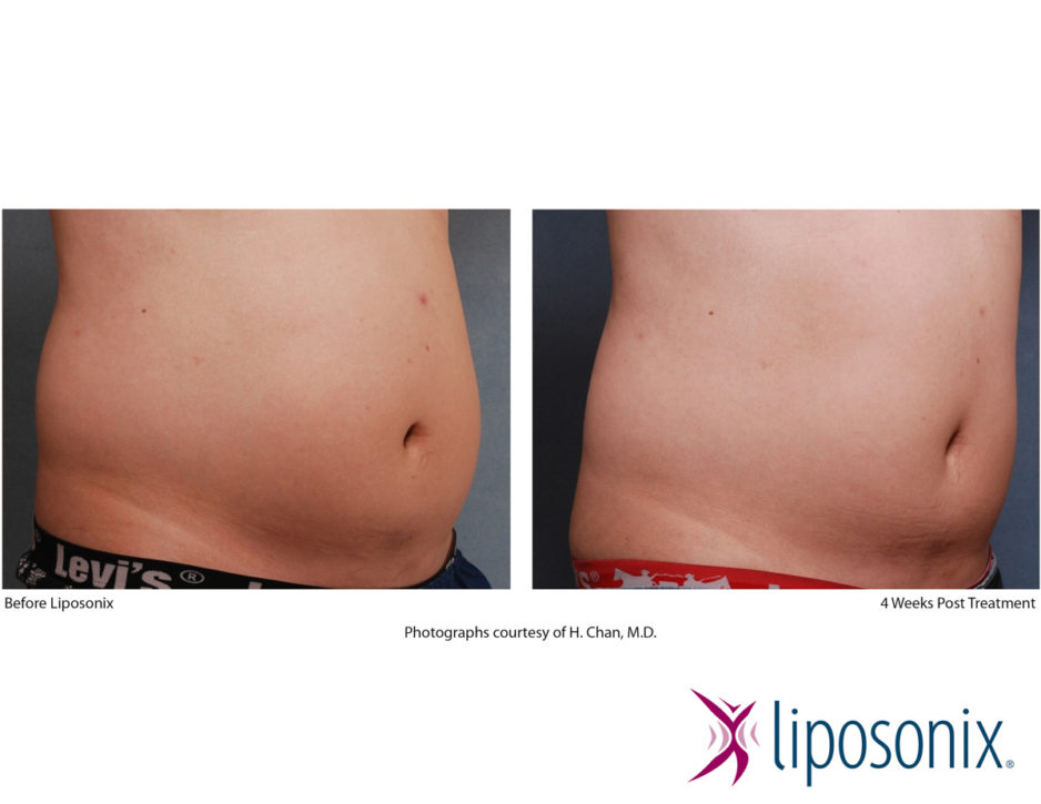 Liposonix vorher nachher