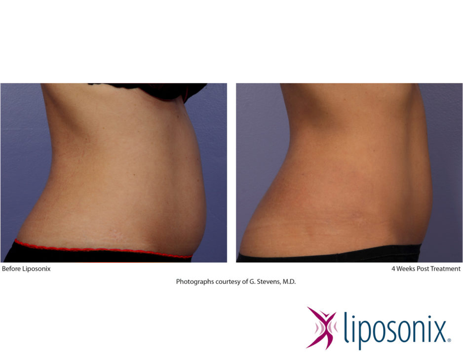 Liposonix vorher nachher