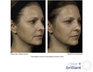 Clear+Brilliant Behandlung